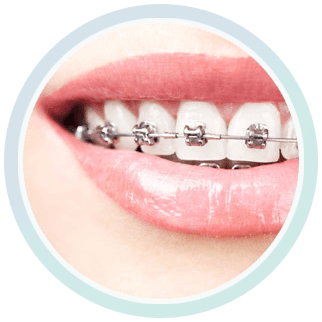 Burnaby Mountain Dental braces