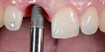 Dental implants service