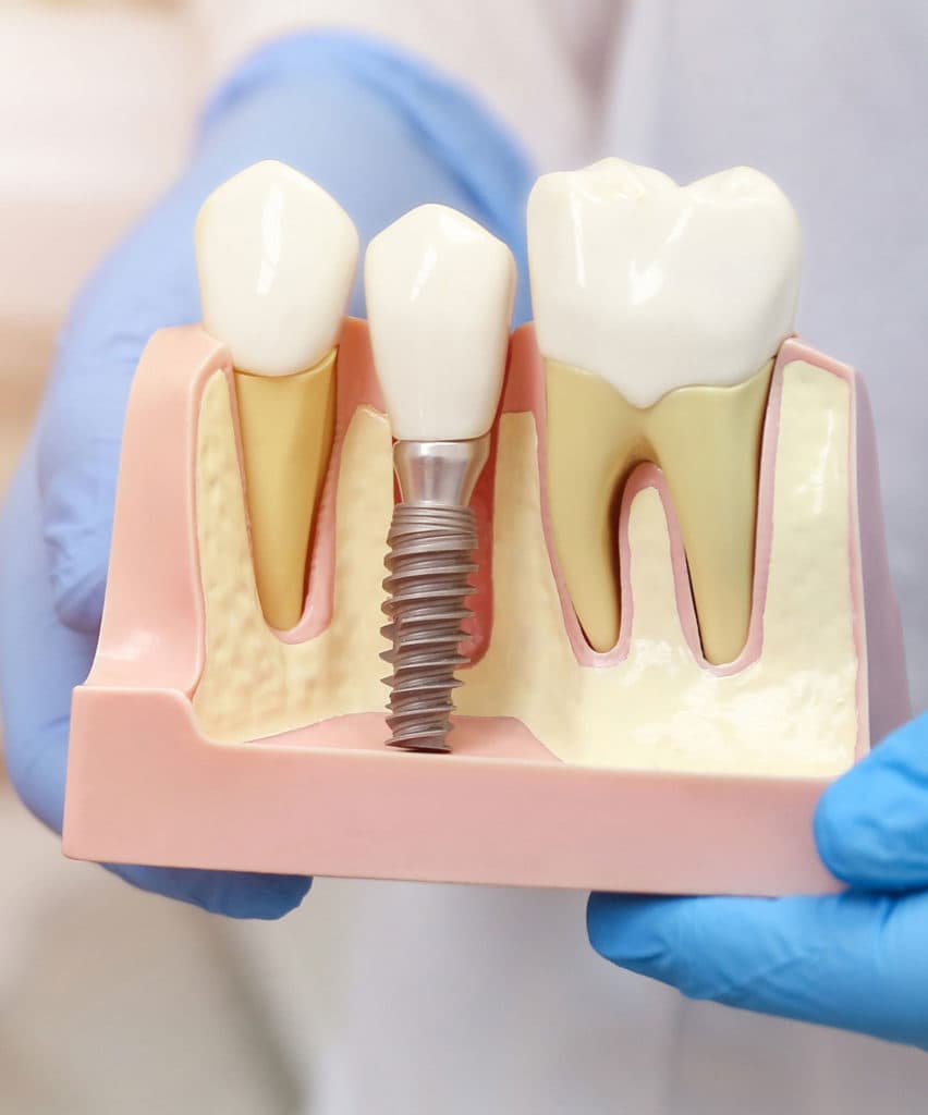 Burnaby Heights dental implants